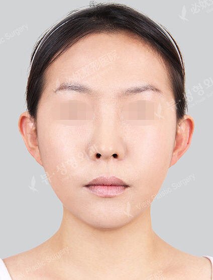 Natural Vline+Zygoma Reduction (3 Months) — After