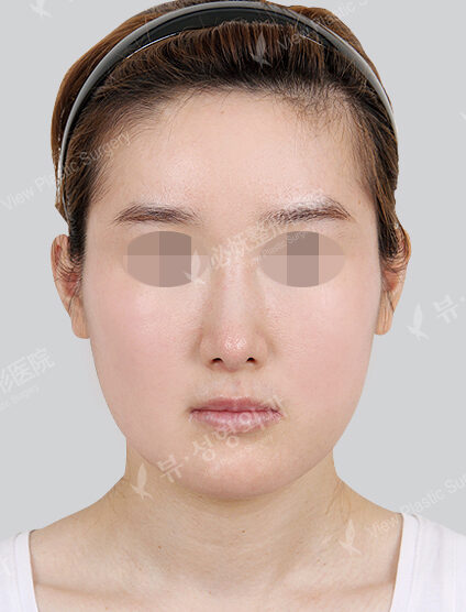 Natural Vline+Zygoma Reduction+Angular Jaw Reduction (1 Months) — Before