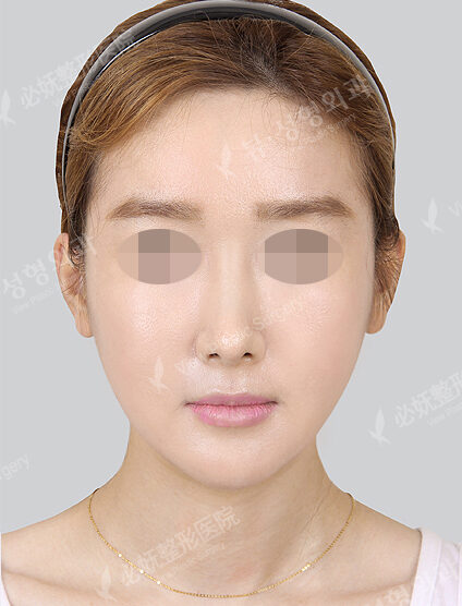 Natural Vline+Zygoma Reduction+Angular Jaw Reduction (1 Months) — After
