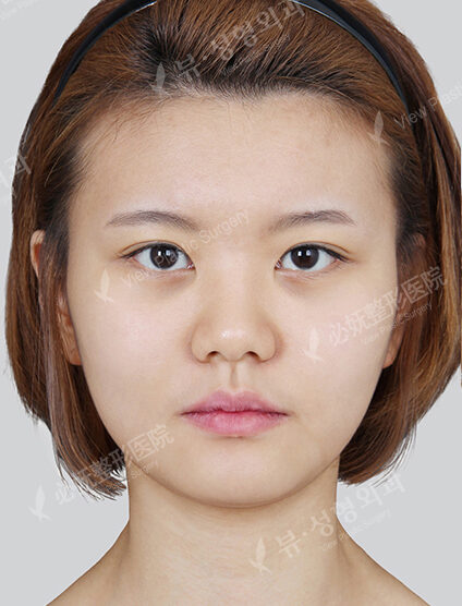 Natural Vline+Zygoma Reduction+Rhinoplasty (3 Months) — Before