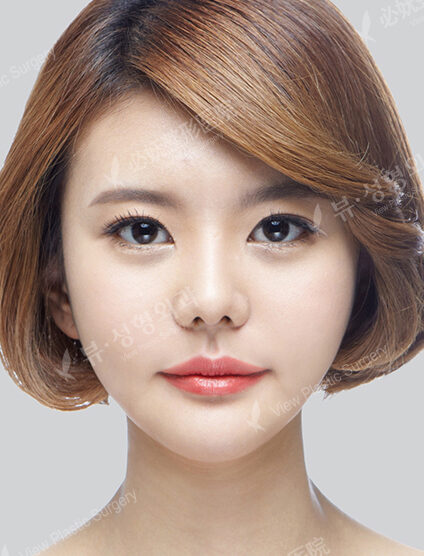 Natural Vline+Zygoma Reduction+Rhinoplasty (3 Months) — After
