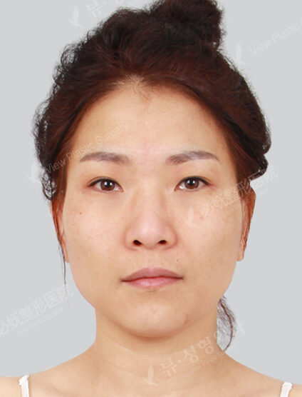 Zygoma Reduction+Hump Nose +Weir Reduction+Fat Graft (Frontal Cheeks , Forehead , Nasolabial)(3 Months) — Before