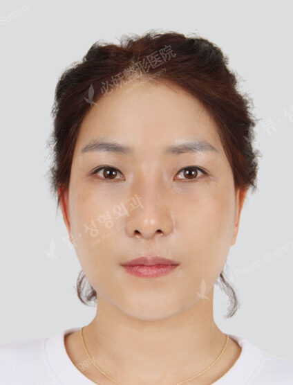 Zygoma Reduction+Hump Nose +Weir Reduction+Fat Graft (Frontal Cheeks , Forehead , Nasolabial)(3 Months) — After