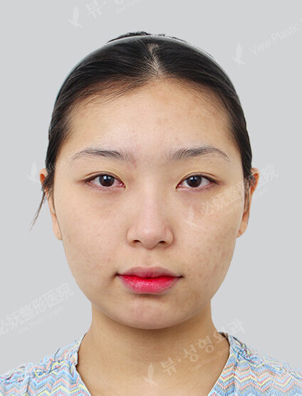 Natural Vline+Zygoma Reduction+Hump Nose +Acculift (Cheeks , ChinLine)(3 Months) — Before