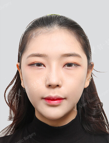 Natural Vline+Zygoma Reduction+Hump Nose +Acculift (Cheeks , ChinLine)(3 Months) — After