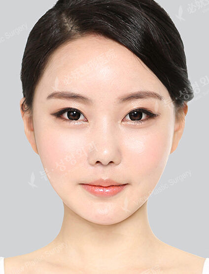 Doll Line (Vline)+ Zygoma Reduction+Rhinoplasty (Revisional Surgery)+ Face Fat Graft (4 Months) — After