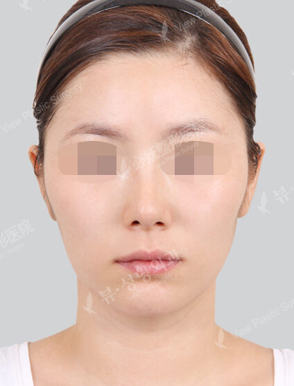 Natural Vline+Zygoma Reduction (1 Months) — Before