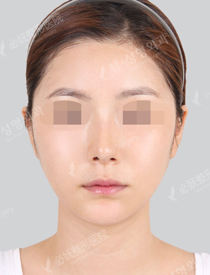Natural Vline+Zygoma Reduction (1 Months) — After