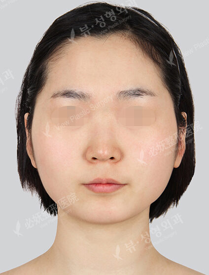 Natural Vline+Zygoma Reduction+Forehead Implant+Rhinoplasty (3 Months) — Before