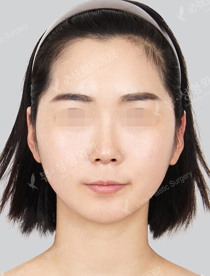 Natural Vline+Zygoma Reduction+Forehead Implant+Rhinoplasty (3 Months) — After