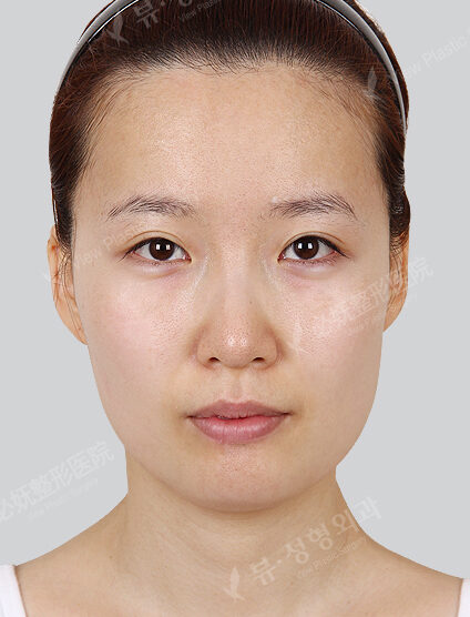 Natural Vline+Zygoma Reduction+Angular Jaw Reduction+Genioplasty (13 Months) — Before