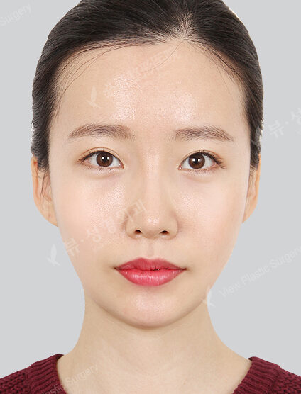 Natural Vline+Zygoma Reduction+Angular Jaw Reduction+Genioplasty (13 Months) — After
