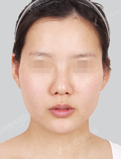 Angular Jaw Reduction+Zygoma Reduction+Rhinoplasty (16 Months) — Before