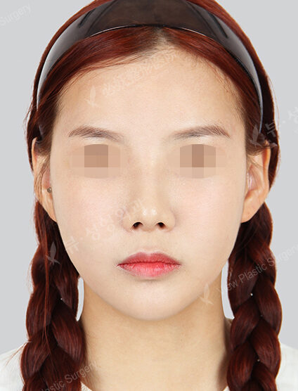 Angular Jaw Reduction+Zygoma Reduction+Rhinoplasty (16 Months) — After