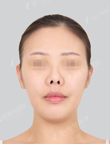 Doll Line (Vline)+ Zygoma Reduction+Revisional Rhinoplasty (3 Months) — Before