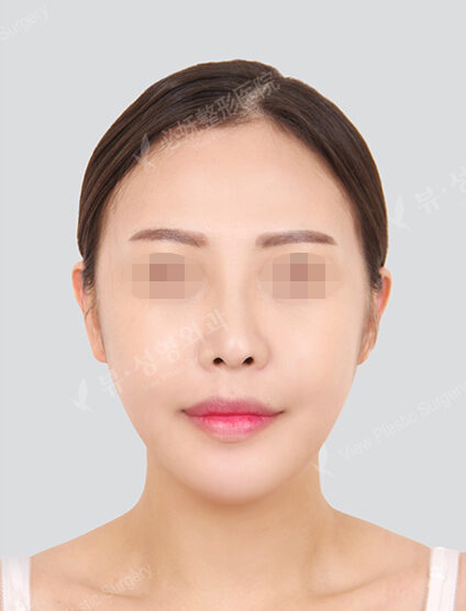 Doll Line (Vline)+ Zygoma Reduction+Revisional Rhinoplasty (3 Months) — After