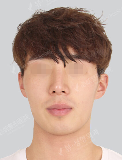 Natural Vline+Zygoma Reduction (3 Months) — Before