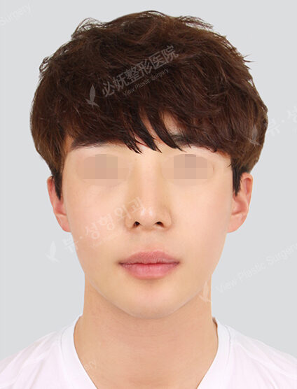 Natural Vline+Zygoma Reduction (3 Months) — After