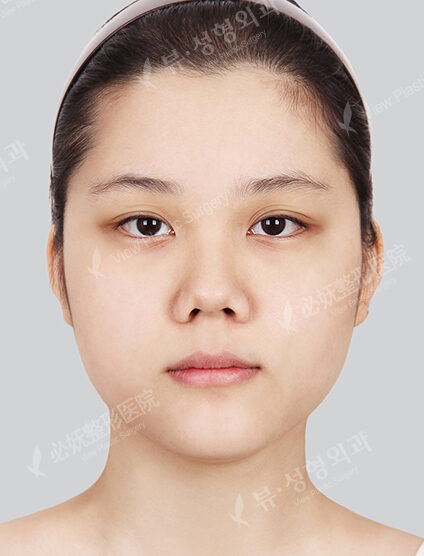 Doll Line (Vline)+ Zygoma Reduction+Rhinoplasty (2 Months) — Before