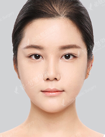 Doll Line (Vline)+ Zygoma Reduction+Rhinoplasty (2 Months) — After