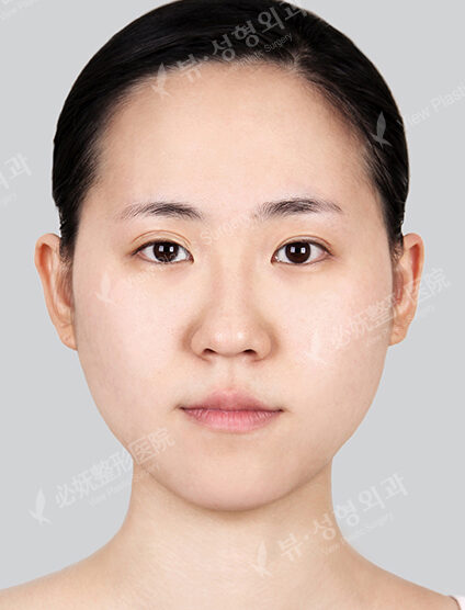 Natural Vline+Zygoma Reduction+Rhinoplasty+Eye Surgery+PA+Forehead Reduction (3 Months) — Before