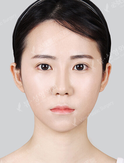 Natural Vline+Zygoma Reduction+Rhinoplasty+Eye Surgery+PA+Forehead Reduction (3 Months) — After