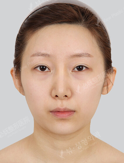 Natural Vline+Zygoma Reduction+Angular Jaw Reduction+Genioplasty+Lateral Canthoplasty+Lower Canthoplasty+Revisional Rhinoplasty(3 Months) — Before