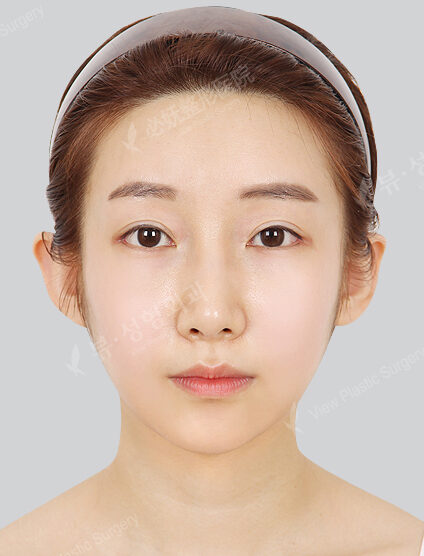 Natural Vline+Zygoma Reduction+Angular Jaw Reduction+Genioplasty+Lateral Canthoplasty+Lower Canthoplasty+Revisional Rhinoplasty(3 Months) — After