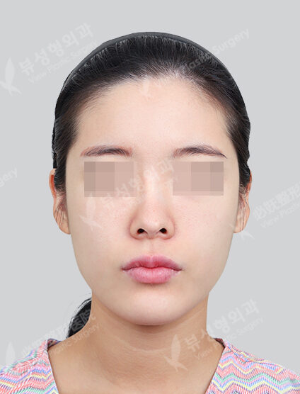 2(Angular Jaw+Chin Tip)(6 Months) — Before