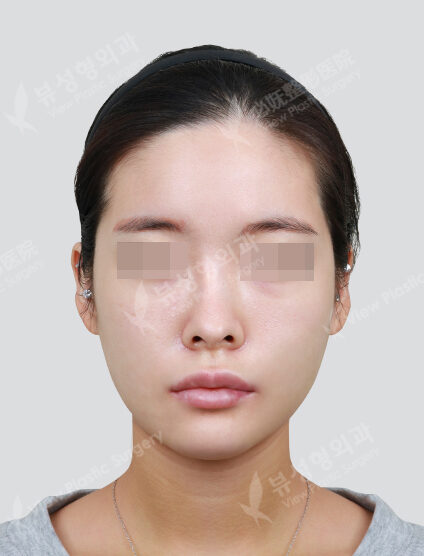 2(Angular Jaw+Chin Tip)(6 Months) — After