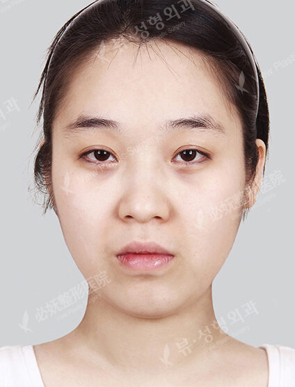 Natural Vline+Zygoma Reduction+Forehead Fat Graft+Rhinoplasty+PA+Acculift+Ptosis Correction (11 Months) — Before