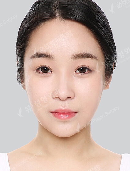 Natural Vline+Zygoma Reduction+Forehead Fat Graft+Rhinoplasty+PA+Acculift+Ptosis Correction (11 Months) — After