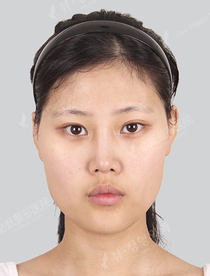 Doll Line (Vline)+ Zygoma Reduction (3 Months) — Before
