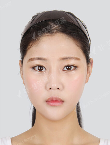 Doll Line (Vline)+ Zygoma Reduction (3 Months) — After