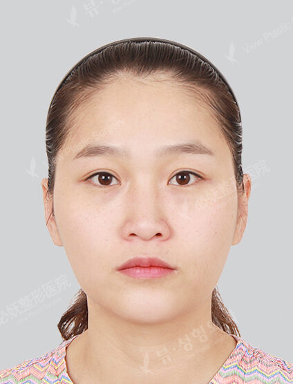 Angular Jaw Reduction+Zygoma Reduction+Hump Nose(3 Months) — Before