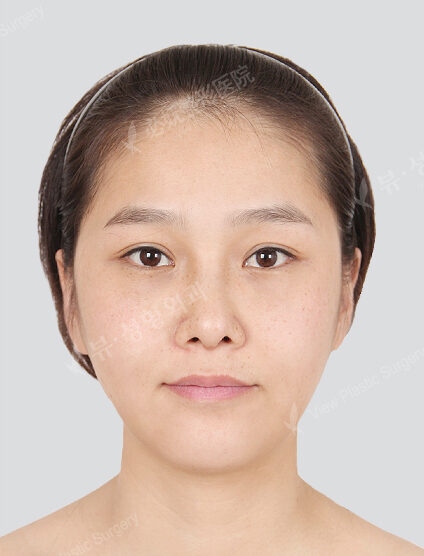 Angular Jaw Reduction+Zygoma Reduction+Hump Nose(3 Months) — After