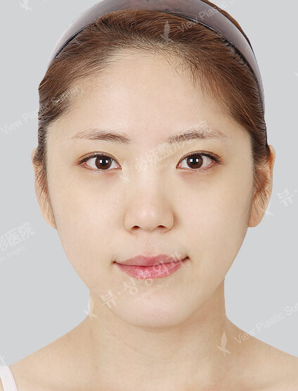 Natural Vline+Rhinoplasty+Fat Graft (5 Months) — Before