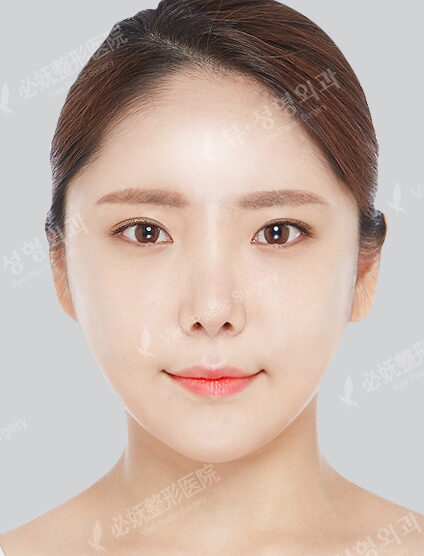 Natural Vline+Rhinoplasty+Fat Graft (5 Months) — After