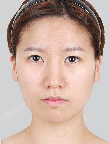 Natural Vline+Zygoma Reduction+Angular Jaw Reduction+Chin Silicone Removal+Frontal Cheek Silicone+Forehead Fat Graft+Epicanthoplasty(6 Months) — Before