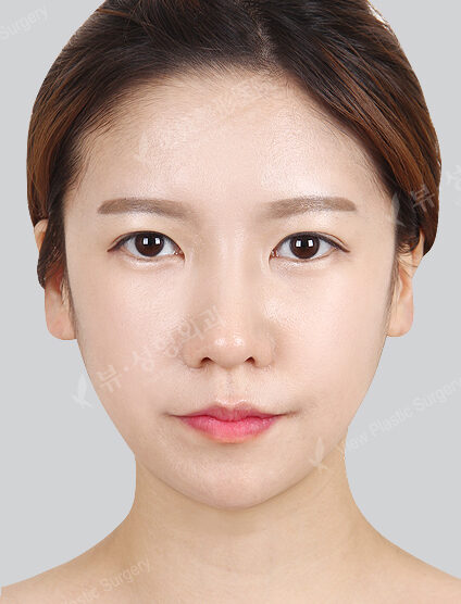 Natural Vline+Zygoma Reduction+Angular Jaw Reduction+Chin Silicone Removal+Frontal Cheek Silicone+Forehead Fat Graft+Epicanthoplasty(6 Months) — After