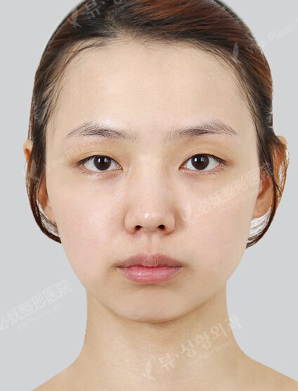 Natural Vline+Zygoma Reduction+Angular Jaw Reduction+Genioplasty+Ptosis Correction+Rhinoplasty(5 Months) — Before