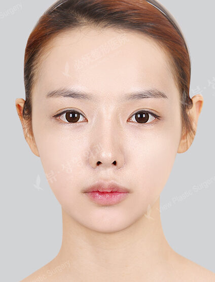 Natural Vline+Zygoma Reduction+Angular Jaw Reduction+Genioplasty+Ptosis Correction+Rhinoplasty(5 Months) — After