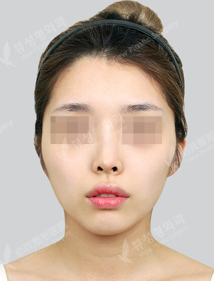 Zygoma Reduction (7 Months) — Before