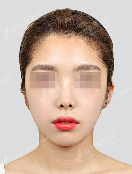 Zygoma Reduction (7 Months) — After