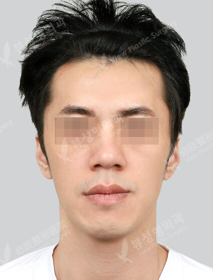 Zygoma Reduction+Genioplasty (6 Months) — Before