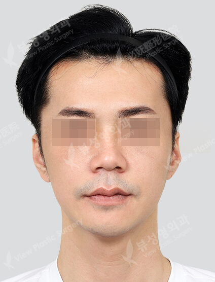 Zygoma Reduction+Genioplasty (6 Months) — After