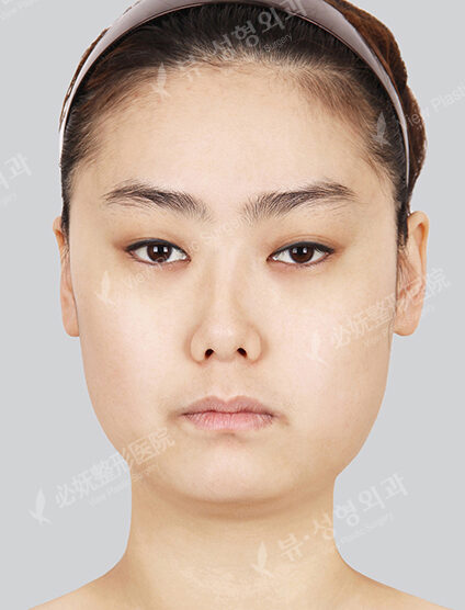 Natural Vline+Zygoma Reduction+Combination Ptosis Correction Surgery+Acculifting+Forehead Implant (2 Months) — Before