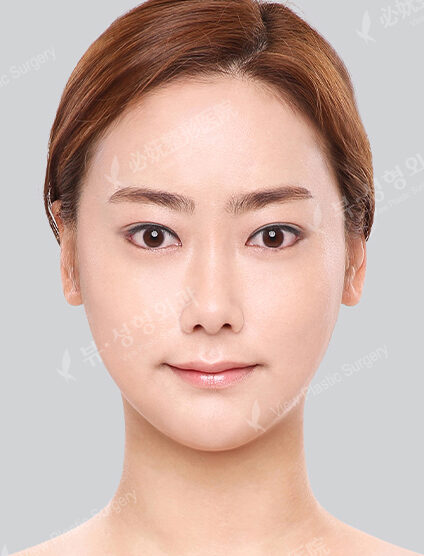 Natural Vline+Zygoma Reduction+Combination Ptosis Correction Surgery+Acculifting+Forehead Implant (2 Months) — After