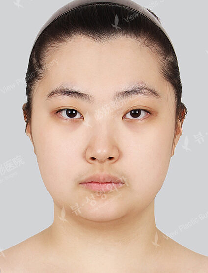 Doll Line (Vline)+ Zygoma Reduction+Rhinoplasty+Eye Surgery (2 Months) — Before