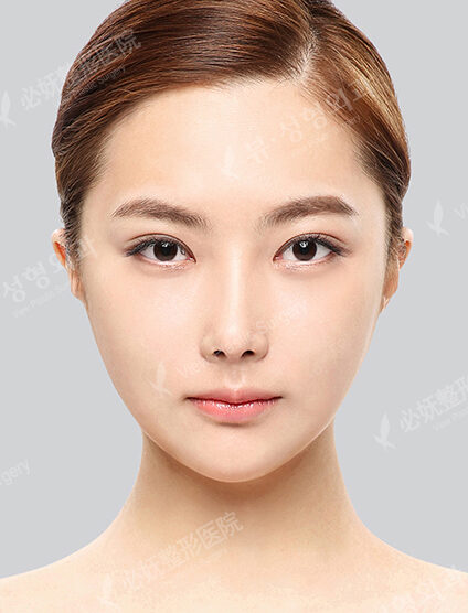 Doll Line (Vline)+ Zygoma Reduction+Rhinoplasty+Eye Surgery (2 Months) — After